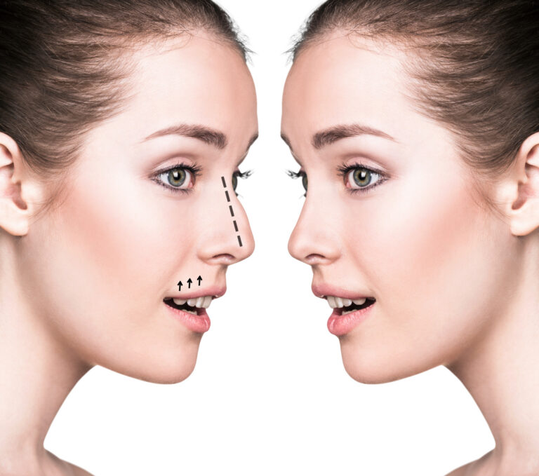 5 Awesome Benefits of Rhinoplasty Surgery