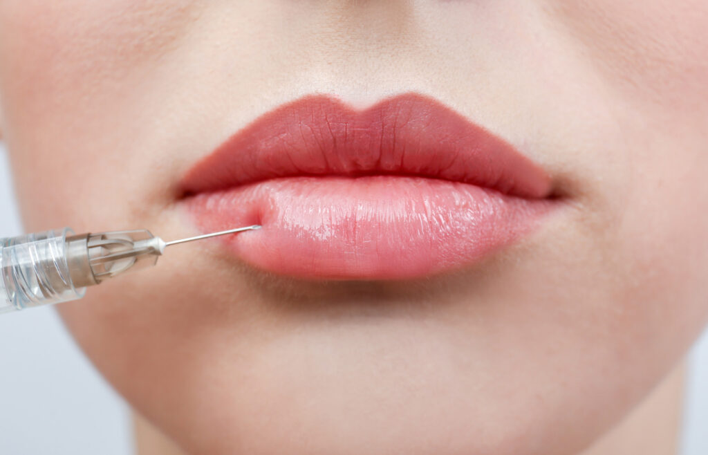 Lip Filler Swelling Stages: What You Need to Know