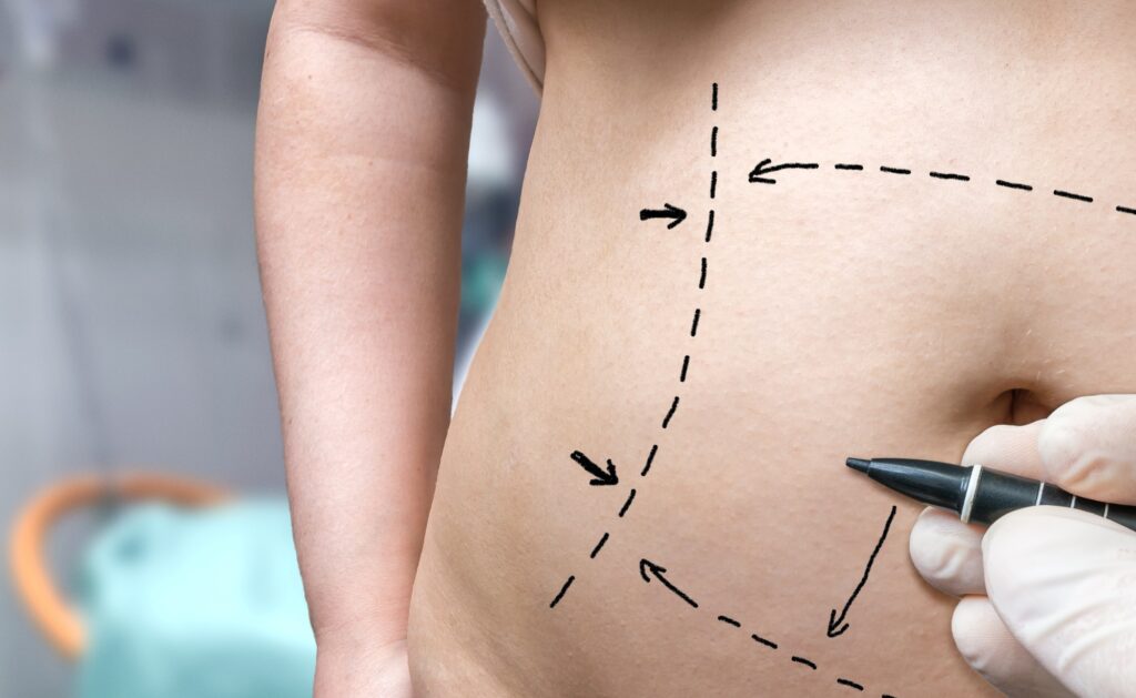 Tummy Tuck vs Lipo: Which Procedure Gets the Best Results?